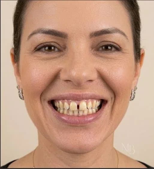 Antes — Antes e depois de facetas de porcelana — Clínica Mariela Baltazar, Tatuapé