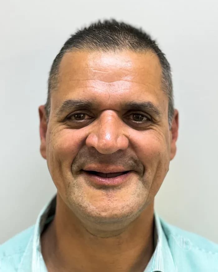 Antes — Antes e depois de prótese dentária — Clínica Mariela Baltazar, Tatuapé
