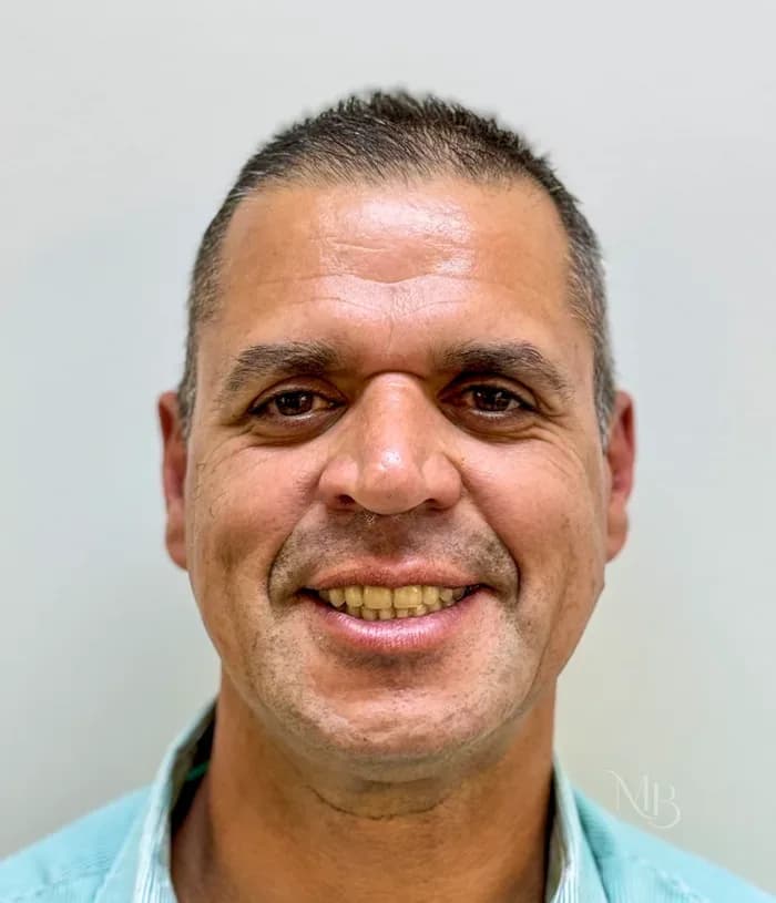 Depois — Antes e depois de prótese dentária — Clínica Mariela Baltazar, Tatuapé