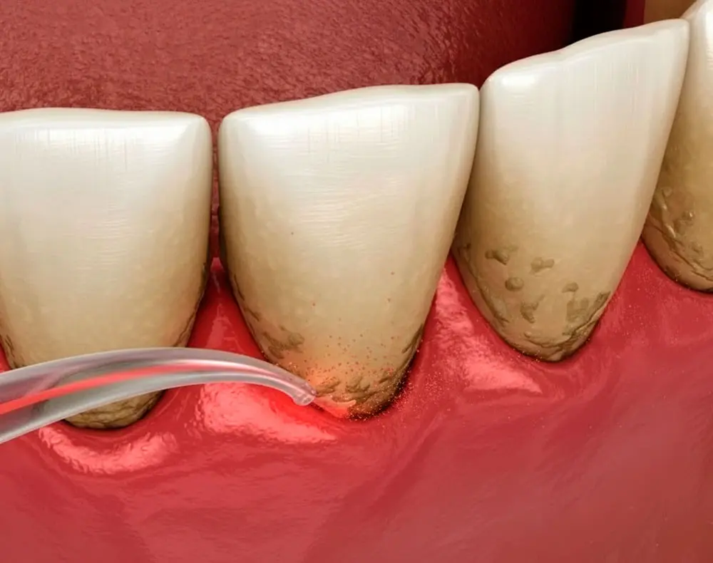 Limpeza dental profissional — Clínica Mariela Baltazar