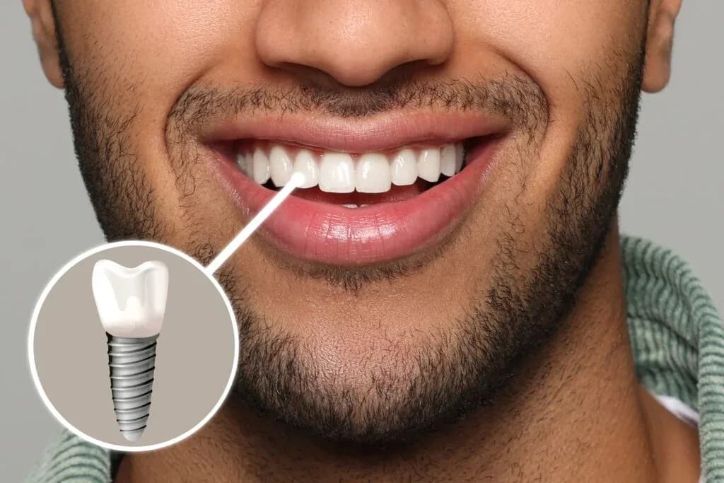 Implante Dentário no Tatuapé: Custos, Recuperação e Benefícios