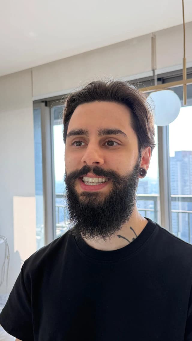 Paciente Felipe Cortez com Invisalign na Clínica Mariela Baltazar