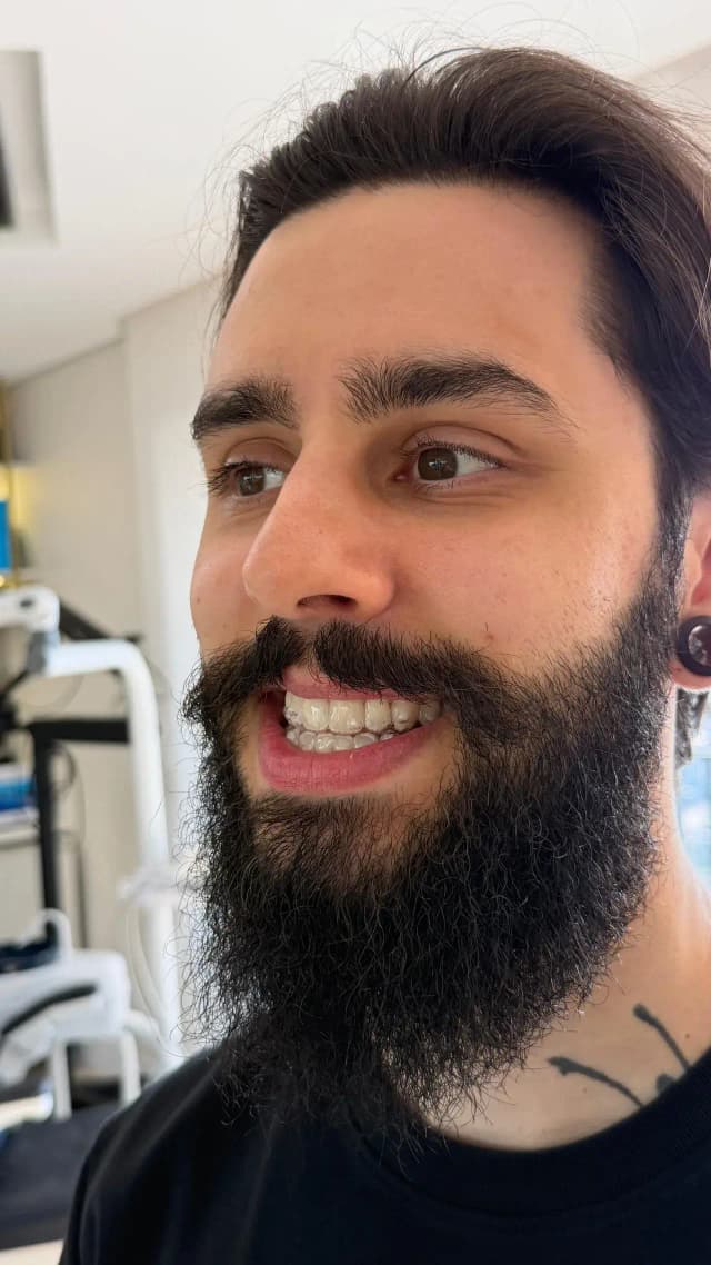Paciente Felipe Cortez com Invisalign na Clínica Mariela Baltazar