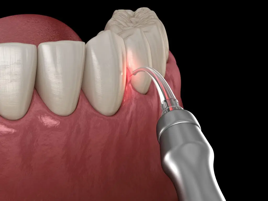 Laserterapia odontológica — Clínica Mariela Baltazar Tatuapé