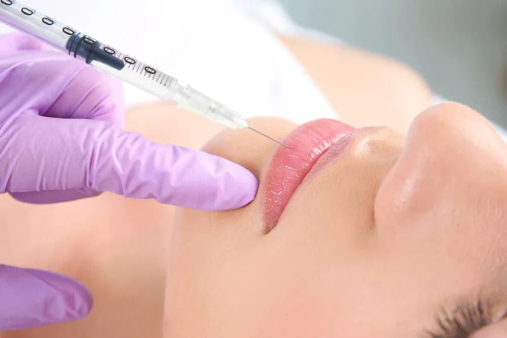 Preenchimento labial com ácido hialurônico — Clínica Mariela Baltazar Tatuapé