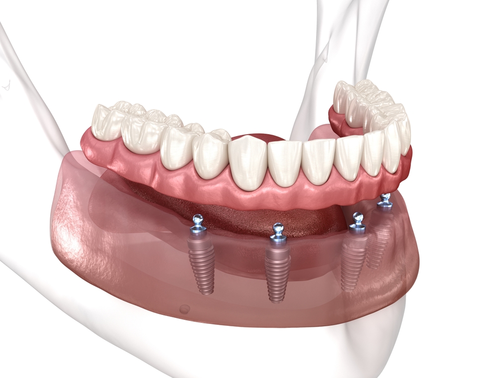 Implantes dentários realizados pela Dra. Mariela Baltazar no Tatuapé e Mooca
