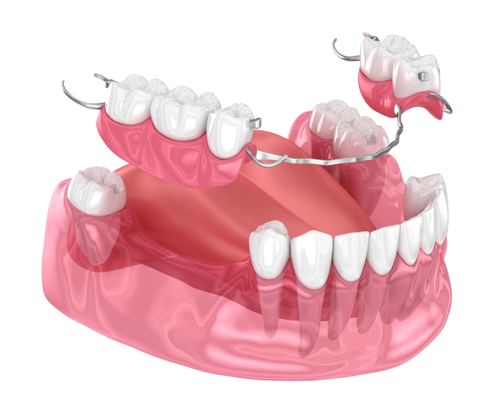 Prótese dentária personalizada feita pela Dra. Mariela Baltazar no Tatuapé e Mooca.