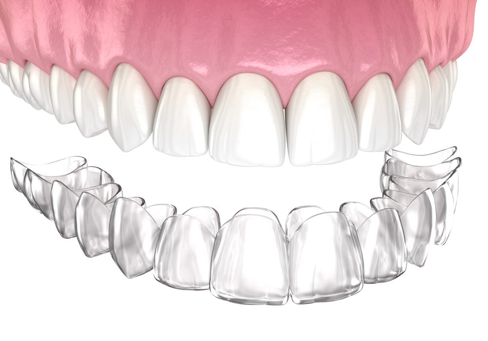 Tratamento com Invisalign na clínica da Dra. Mariela Baltazar no Tatuapé e Mooca