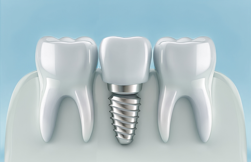 Implantes dentários realizados pela Dra. Mariela Baltazar no Tatuapé e Mooca