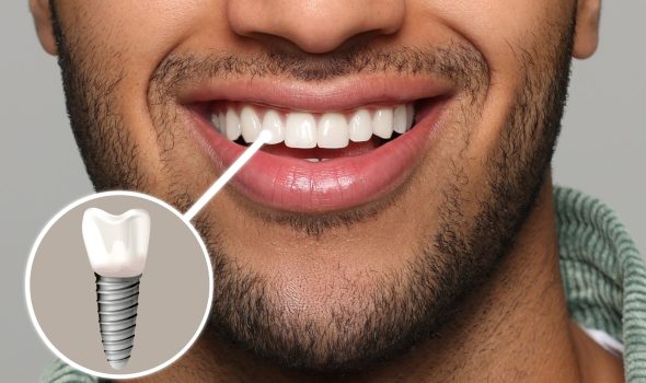 Implante Dentário no Tatuapé e Mooca – Dra. Mariela Baltazar Implante dentário na clínica da Dra. Mariela Baltazar no Tatuapé e Mooca.